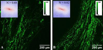 Imaging of colorectal adenomas with pseudoinvasion and malignant polyps using two-photon excitation microscopy